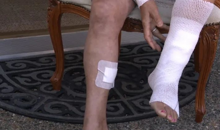 惨！加拿大女子遛狗回家遭一群浣熊撕咬！腿上留下血洞抓痕！