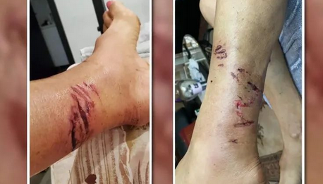 惨！加拿大女子遛狗回家遭一群浣熊撕咬！腿上留下血洞抓痕！