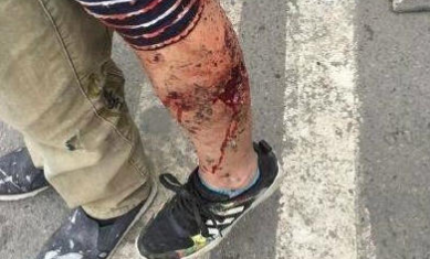 成都一母亲为护子 被恶狗撕咬5分钟