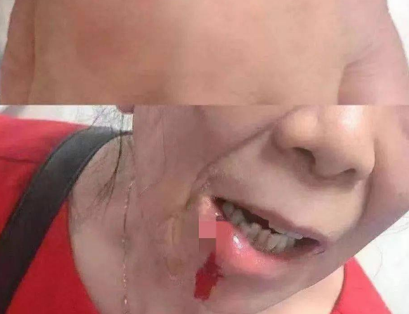 恶犬伤人!紧急调疫苗!21人入院,最小才3岁!近期高发,医生紧急提醒