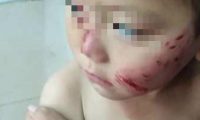 3岁娃街边被流浪狗撕咬,半张脸破相缝17针,妈妈:把疯狗打死了