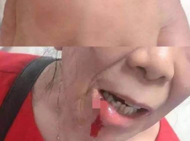 恶犬伤人！紧急调疫苗！21人入院，最小才3岁！近期高发，医生紧急提醒