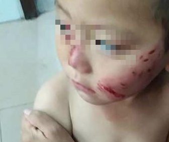 3岁娃街边被流浪狗撕咬,半张脸破相缝17针,妈妈:把疯狗打死了