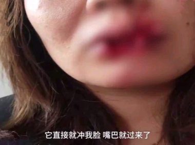 女子给朋友狗喂食，嘴唇被咬掉一半，医生：咬掉那一半找不到，已经没有办法复