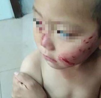 3岁娃街边被流浪狗撕咬,半张脸破相缝17针,妈妈:把疯狗打死了